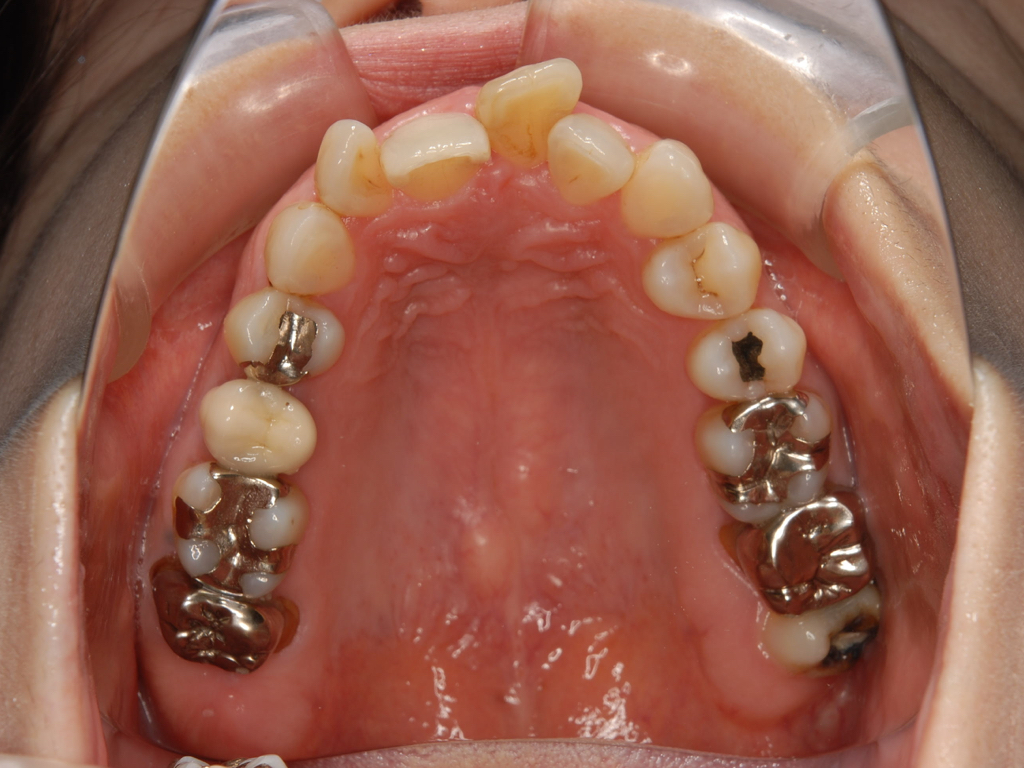 銀歯歯周病矯正.003