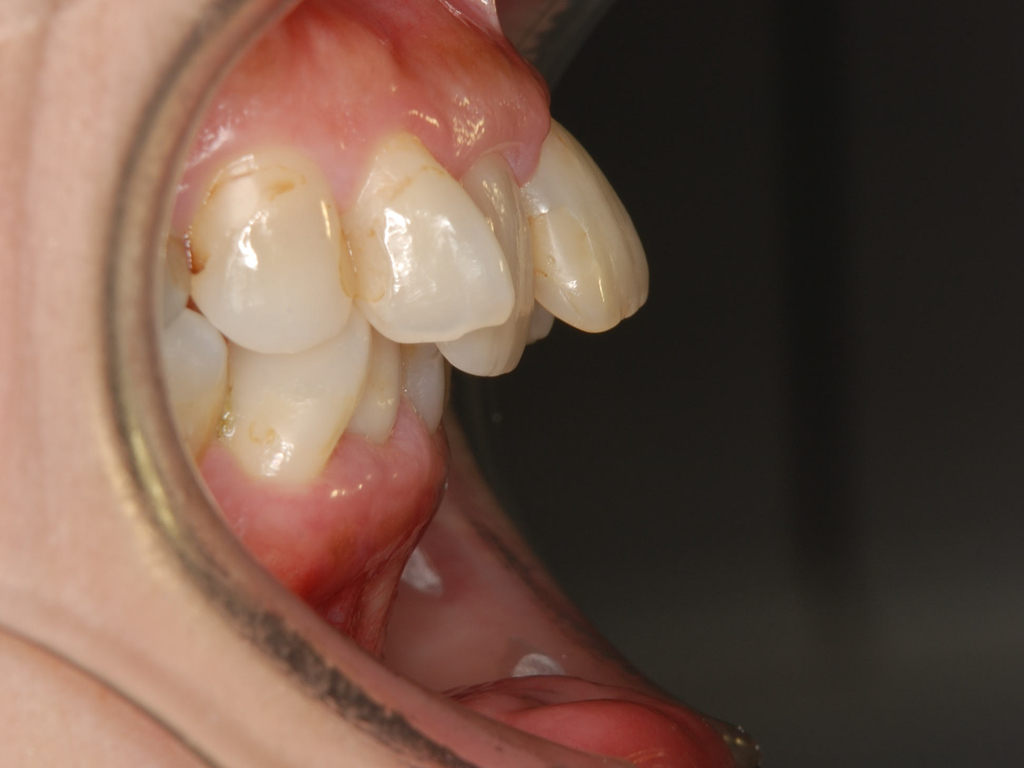 銀歯歯周病矯正.002