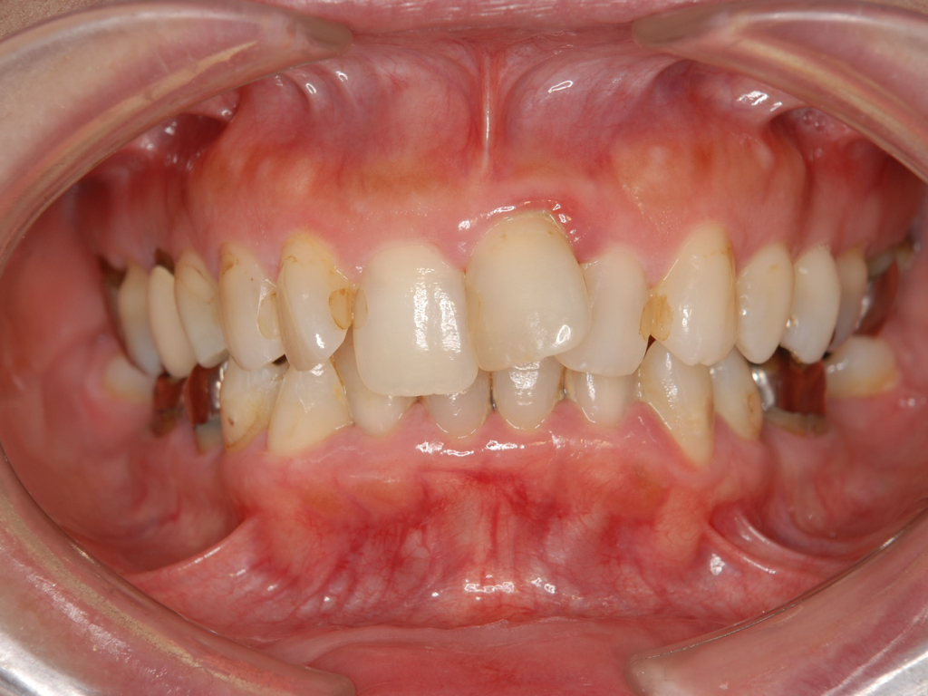銀歯歯周病矯正.001