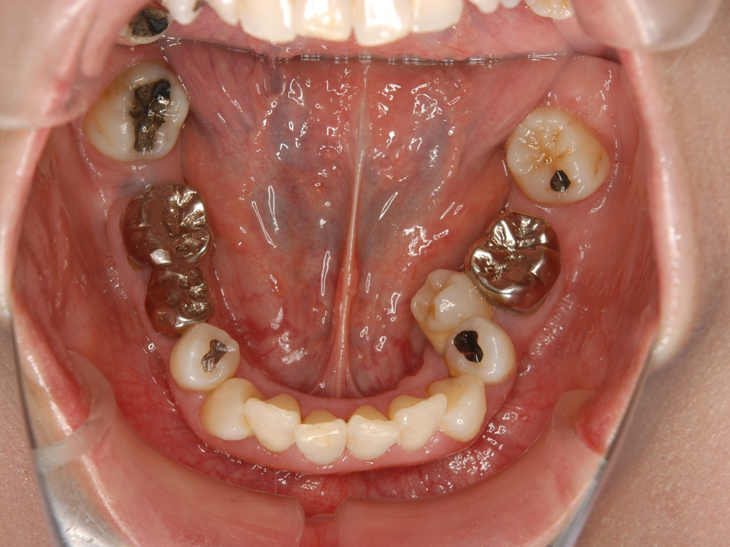 銀歯歯周病矯正.004