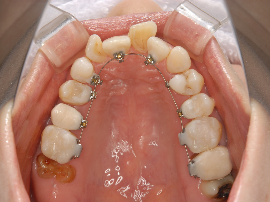 銀歯歯周病矯正.005