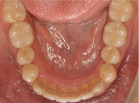 オールセラミックス