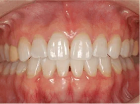 ホワイトニング