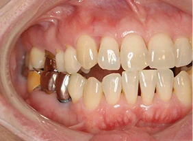 矯正治療とインプラント治療を併用したかみ合わせの治療