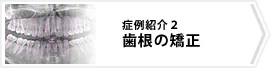 症例2 歯根の矯正