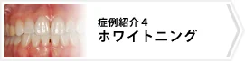 症例4 ホワイトニング
