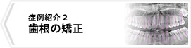 症例2 歯根の矯正