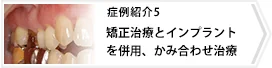 症例5 矯正治療とインプラントを併用、かみ合わせ治療