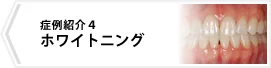 症例4 ホワイトニング