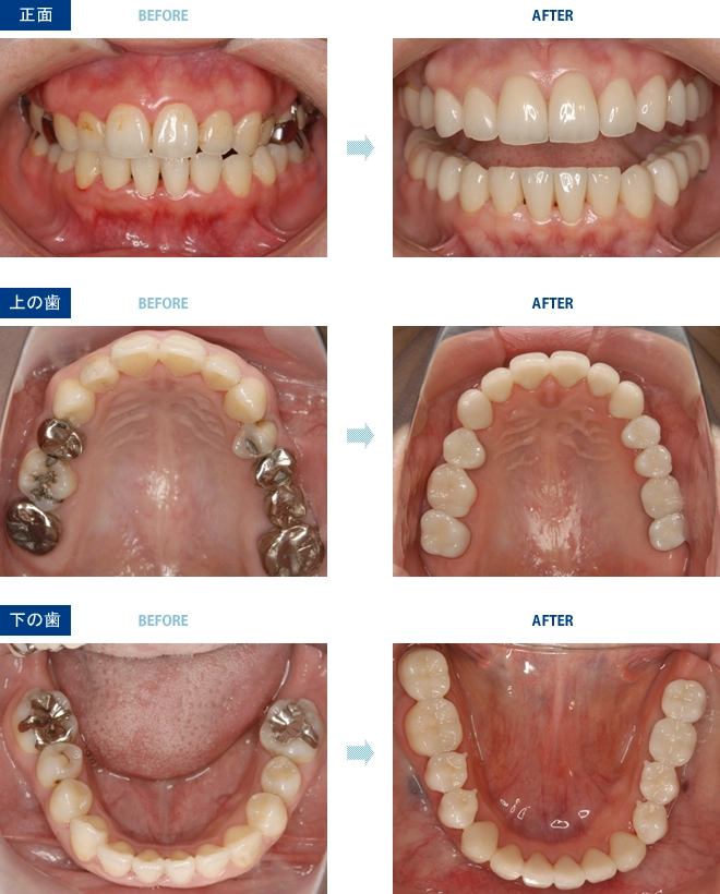 インプラントの事例