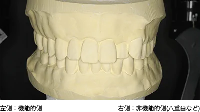 左側：機能的側 右側：非機能的側（八重歯など）
