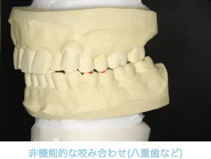 非機能的な咬み合わせ(八重歯など)