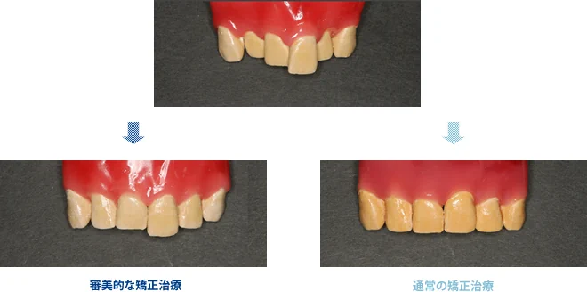 審美的な矯正治療と通常の矯正治療の比較