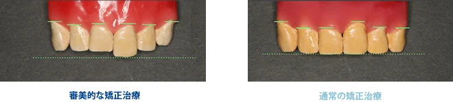 審美的な矯正治療と通常の矯正治療の比較