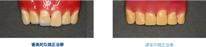審美的な矯正治療と通常の矯正治療の比較