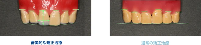 審美的な矯正治療と通常の矯正治療の比較