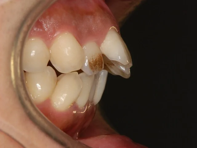 出っ歯（上顎前突）