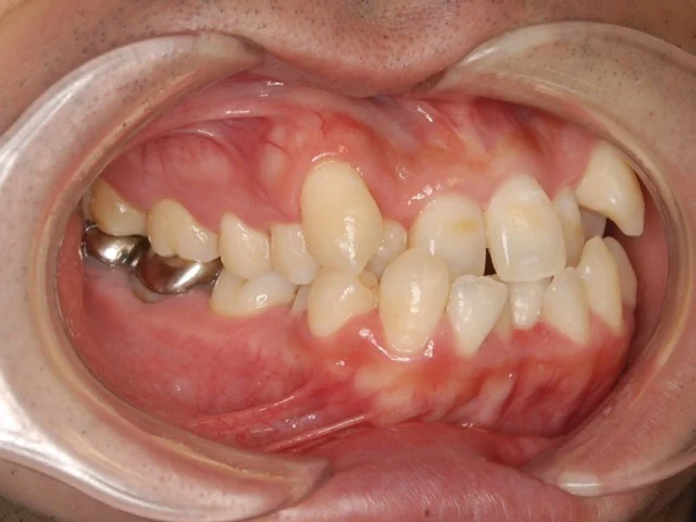 受け口（反対咬合）