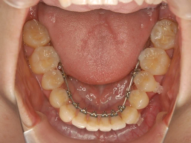上下裏側の見えない矯正（舌側矯正）