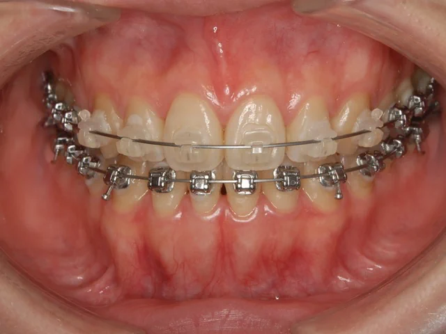上下表側の矯正（表側矯正）