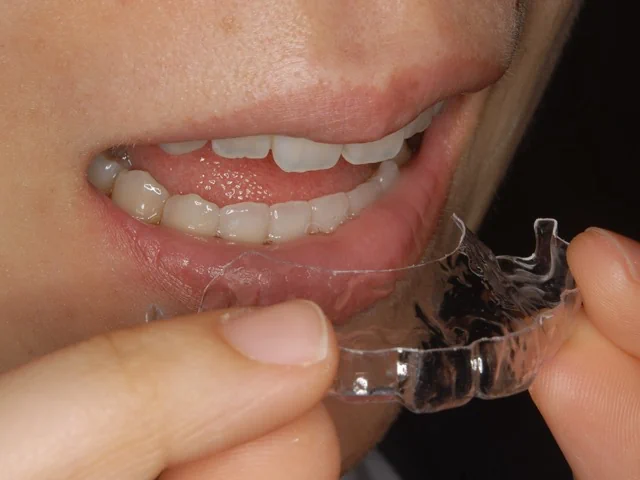 マウスピース矯正