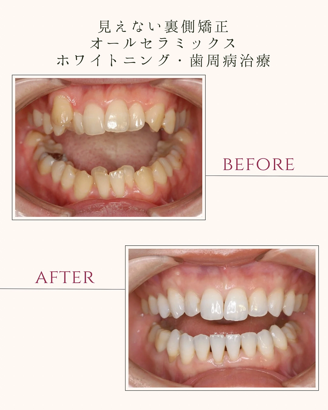 見えない裏側矯正 オールセラミックス ホワイトニング・歯周病治療