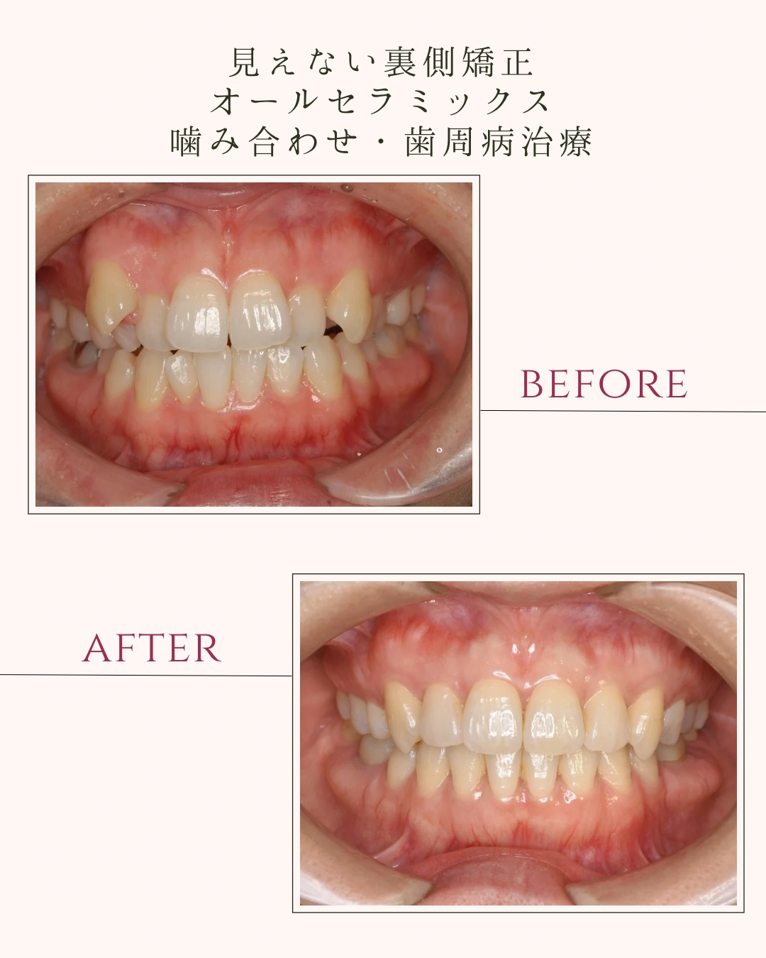 見えない裏側矯正 オールセラミックス 噛み合わせ・歯周病治療