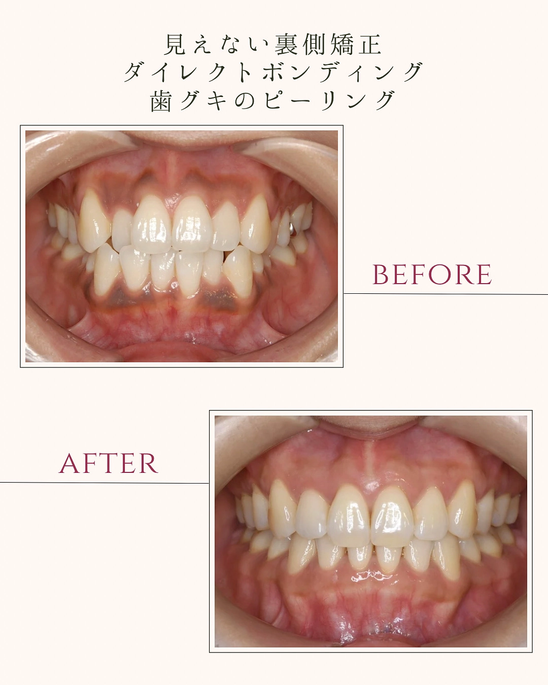 見えない裏側矯正 ダイレクトボンディング 歯グキのピーリング
