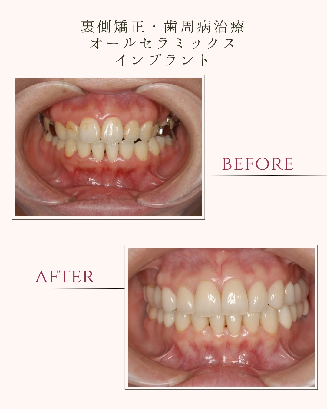 裏側矯正・歯周病治療 オールセラミックス インプラント