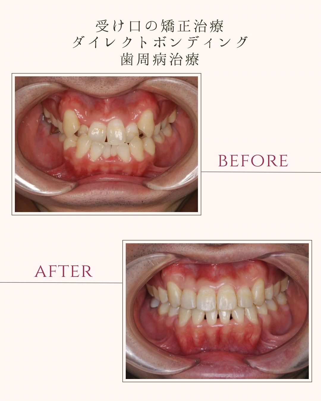 受け口の矯正治療 ダイレクトボンディング 歯周病治療