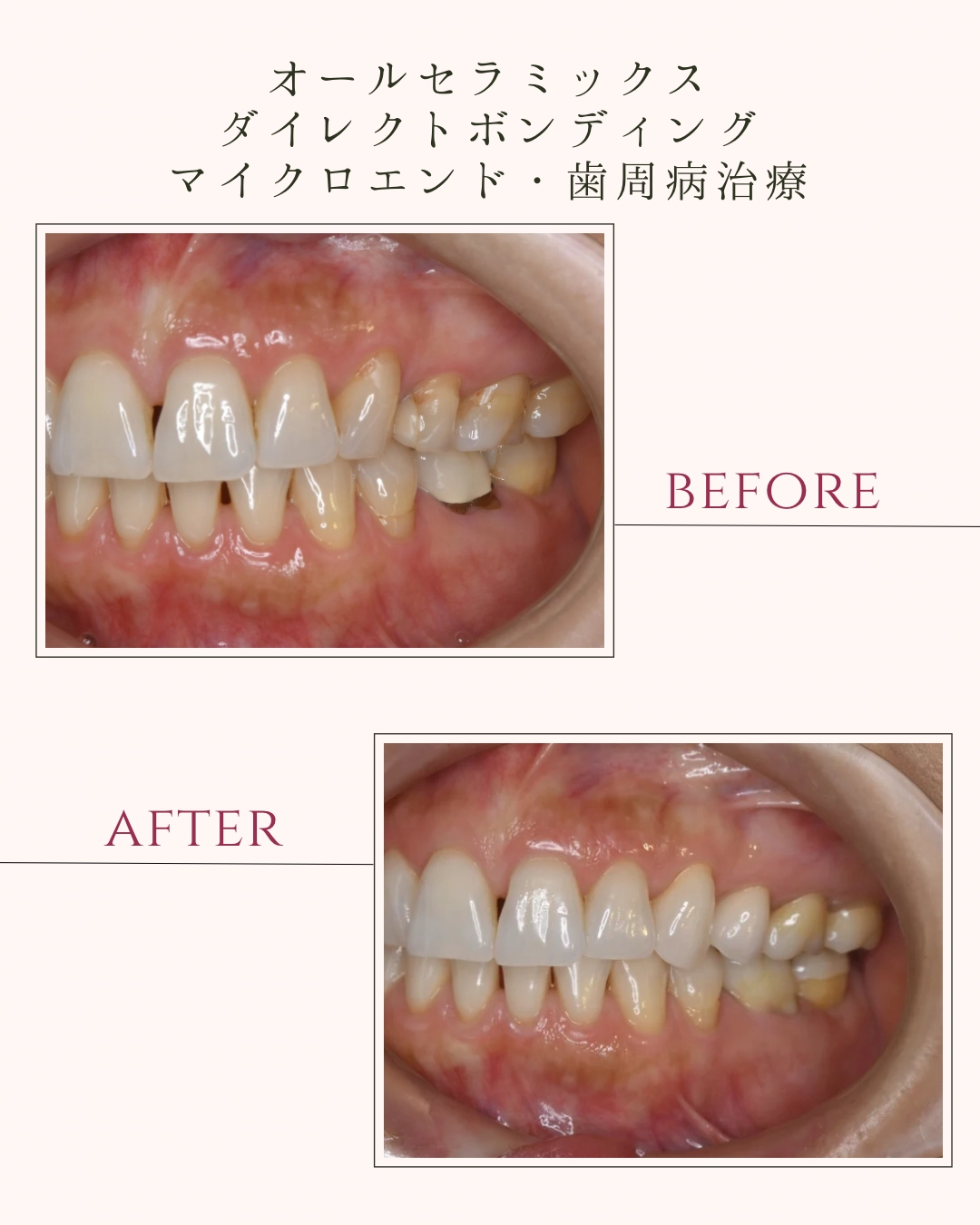 オールセラミックス ダイレクトボンディング マイクロエンド・歯周病治療