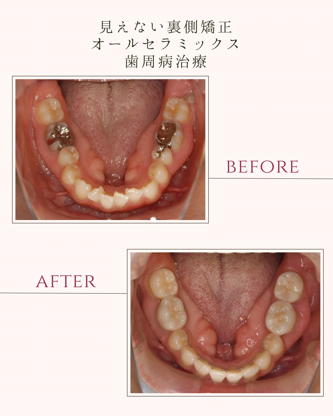 見えない裏側矯正 オールセラミックス 歯周病治療
