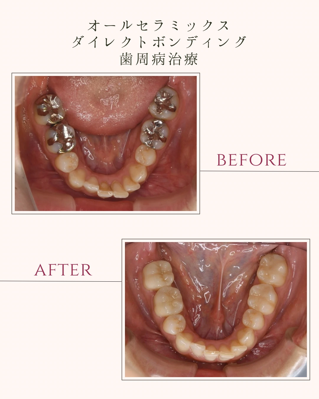 オールセラミックス ダイレクトボンディング 歯周病治療