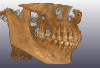 CT検査により立体的に骨格と歯並びを診断します