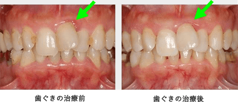 歯周病の治療と管理