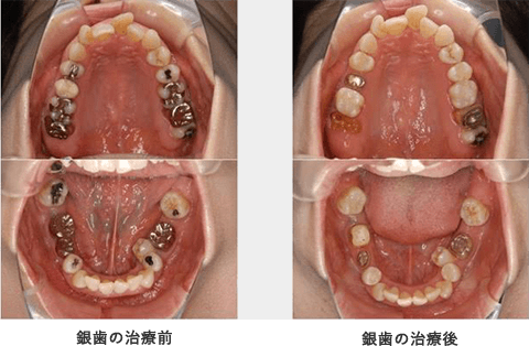 銀歯や差し歯の治療