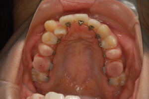 福岡天神｜渡辺通さとう歯科・矯正歯科 20代女性の裏側矯正中の上顎写真