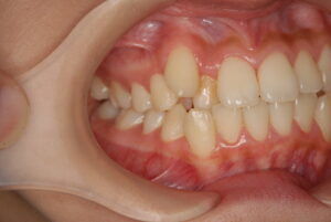 福岡天神｜渡辺通さとう歯科・矯正歯科 20代女性の裏側矯正前の右側歯並び写真