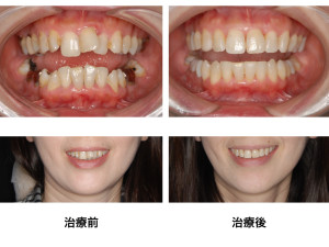 福岡市天神｜渡辺通さとう歯科・矯正歯科40代女性の矯正と銀歯治療前後の笑顔の比較写真