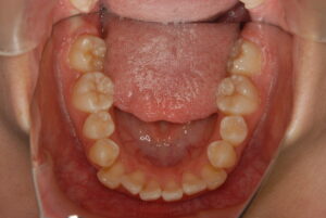 福岡天神｜渡辺通さとう歯科・矯正歯科 20代女性の裏側矯正前の下顎歯並び写真