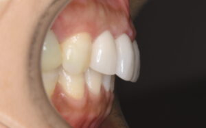 福岡市 前歯セラミックやり直し マイクロエンド 精密治療 後のAfter