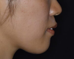 福岡天神｜渡辺通さとう歯科・矯正歯科｜20代女性の裏側矯正の写真