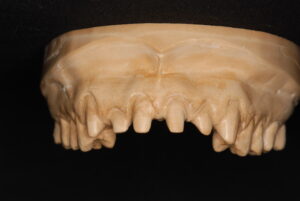 歯を大きく削った写真｜福岡天神｜渡辺通さとう歯科・矯正歯科