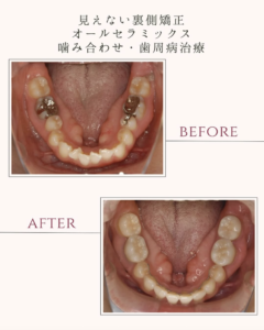 福岡 天神 日曜診療 矯正＋セラミックのビフォーアフター症例写真