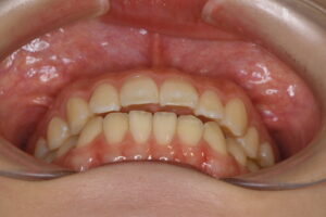 他院でのマウスピース矯正で前歯はぱっと見並んだが、咬み合わせが悪く顎関節症に悩む20代女性の前歯の咬み合わせ写真｜福岡天神|渡辺通さとう歯科・矯正歯科