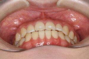 裏側ワイヤー矯正でやり直して咬み合わせも安定した20代女性の前歯の咬み合わせ写真｜福岡天神｜渡辺通さとう歯科・矯正歯科