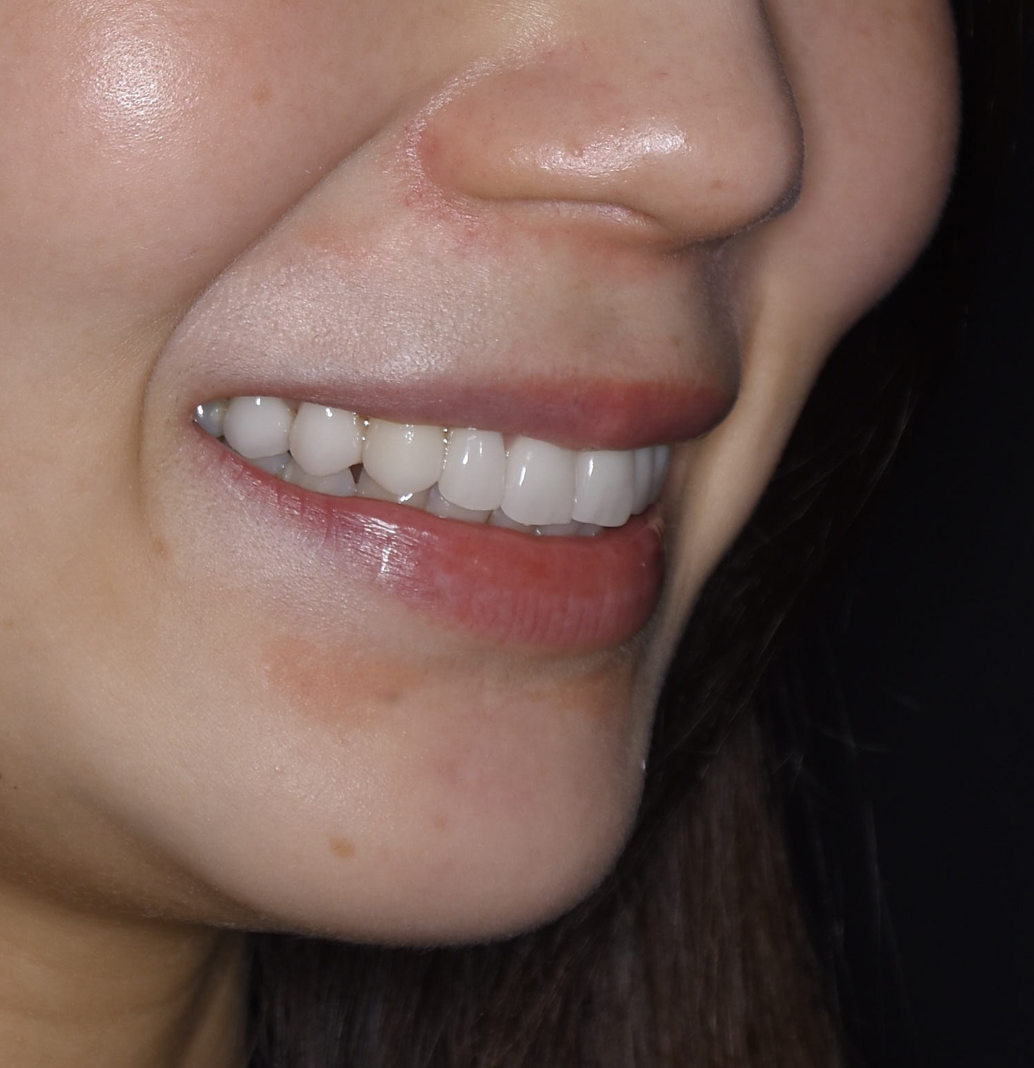 福岡市天神で「前歯のセラミックやり直し治療」—精密治療で根本から改善した30代女性の症例