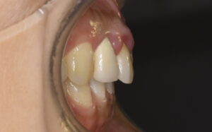 福岡市 前歯セラミック 適合不良 歯ぐきの腫れ Before