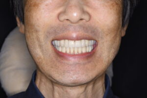 50代男性｜歯並びガタガタ｜重度歯周病｜裏側矯正治療終了｜セラミックできれいな白い歯としっかりしたかみ合わせ｜すべての治療終了後の患者様の笑顔写真｜福岡天神｜渡辺通さとう歯科・矯正歯科