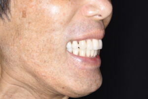 50代男性｜歯並びガタガタ｜重度歯周病｜裏側矯正治療終了｜セラミックできれいな白い歯としっかりしたかみ合わせ｜満足の患者様笑顔写真｜福岡天神｜渡辺通さとう歯科・矯正歯科